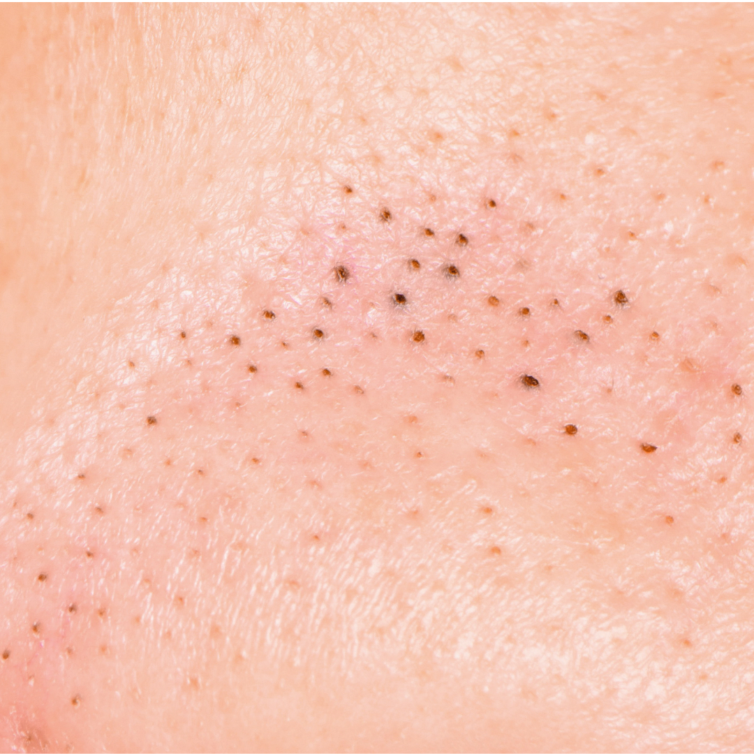 How to Get Rid of Blackheads – DERMALA